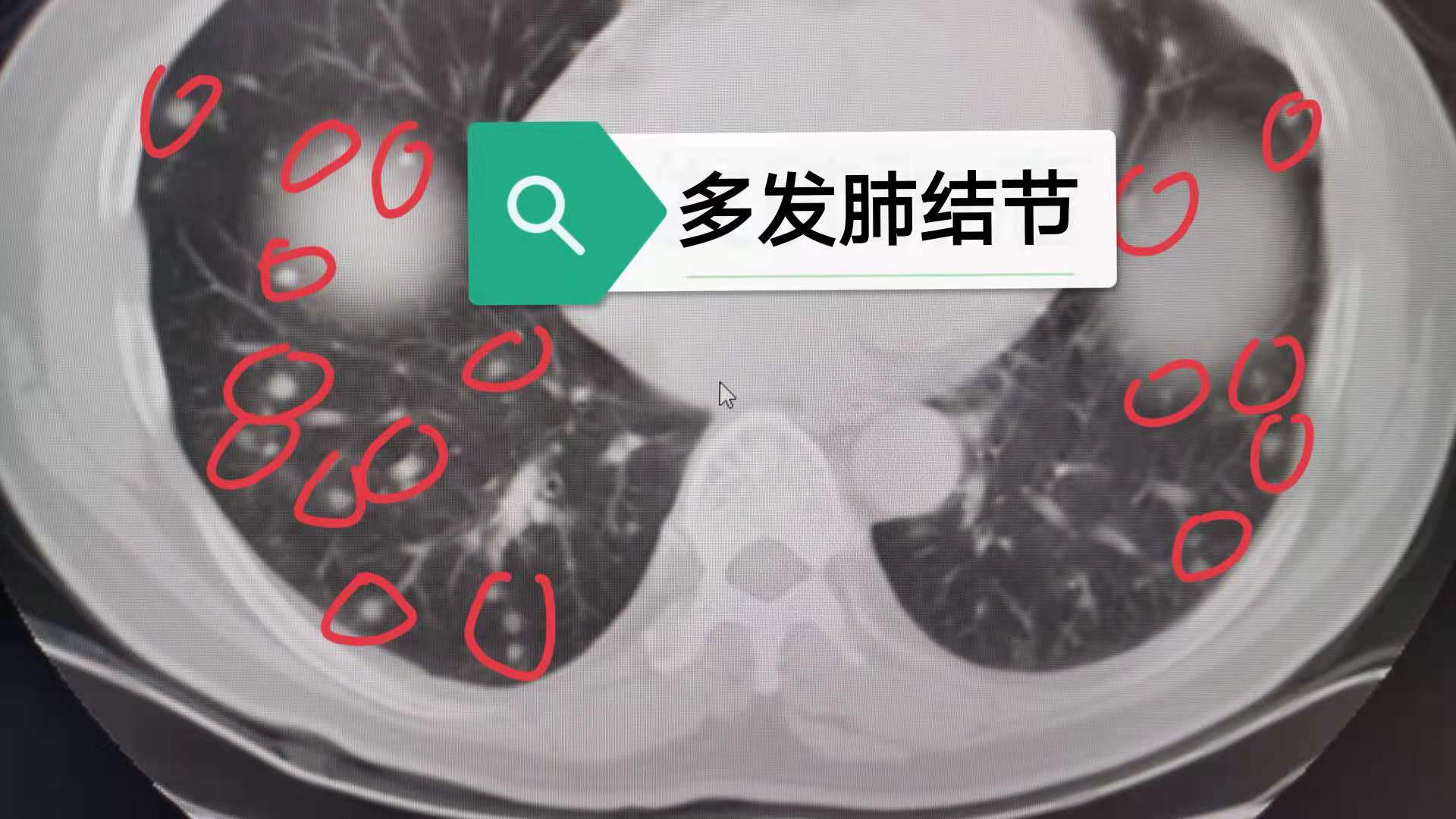 最新肺结节贴吧动态热议与探讨