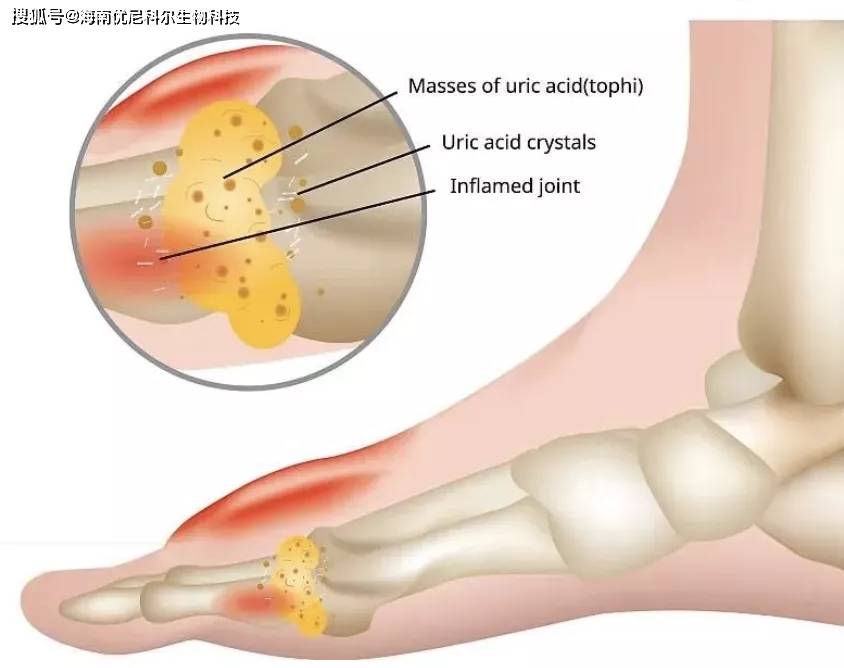 痛风最新治疗方法概览